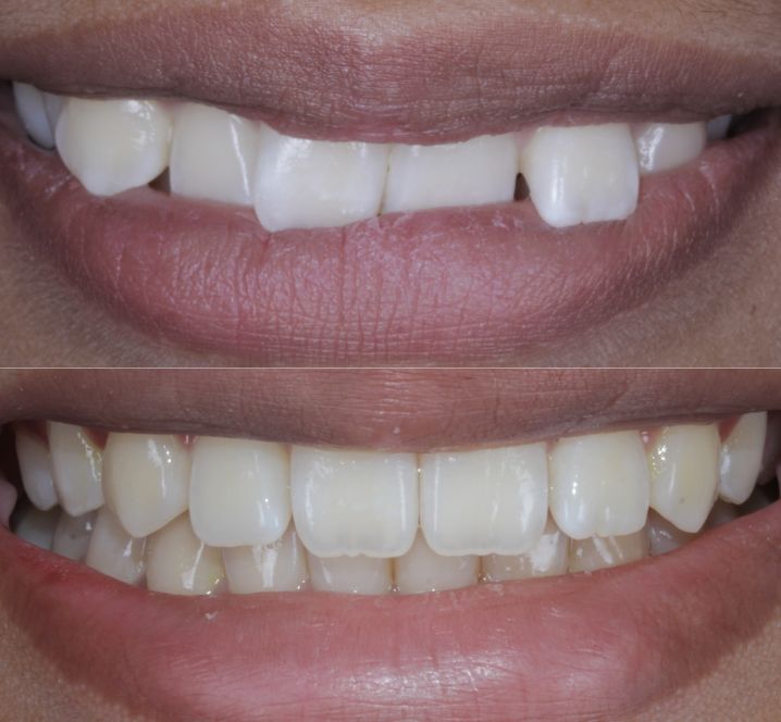 After close up mouthBefore close up mouth