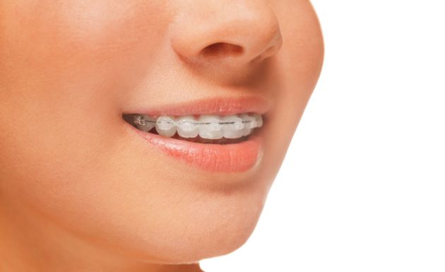 Eastbury Dental Clear Fixed Braces