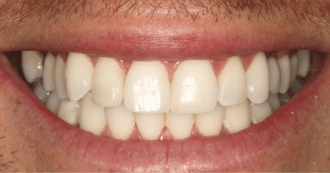 After - Eastbury Dental Practice