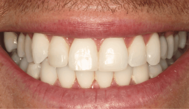 After - Eastbury Dental Practice