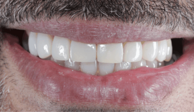 After - Eastbury Dental Practice