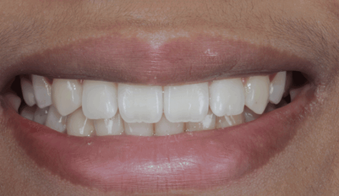 After - Eastbury Dental Practice