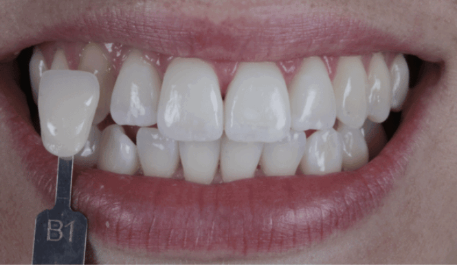 After - Eastbury Dental Practice