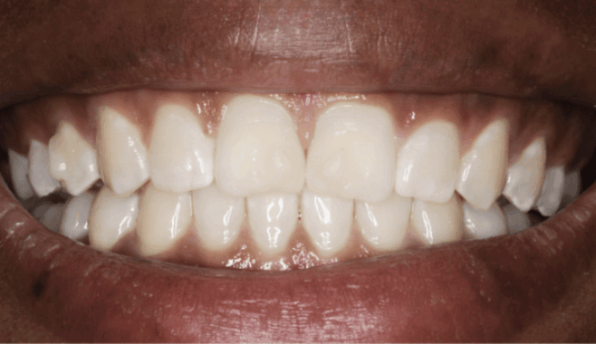 After - Eastbury Dental Practice