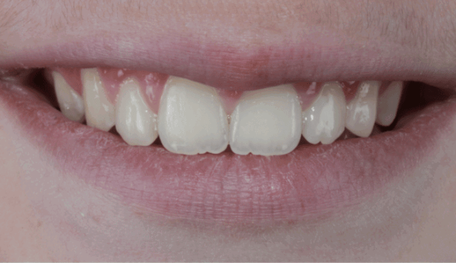 After - Eastbury Dental Practice